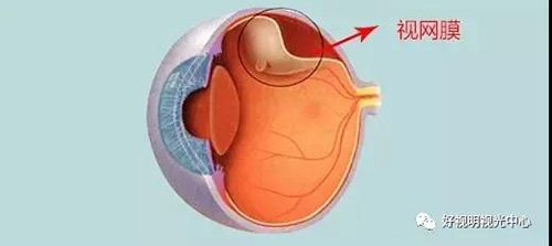 高度近视的危害，剧烈运动可能导致视网膜脱落！